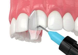 composite-bonding-gap-teeth-eaton-rapids-mi
